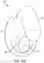Fig. 33 - Pressure field stimulation device