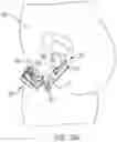 Fig. 33 - Pressure field stimulator having a cup integrated with a sheath