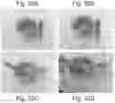 Fig. 41 - Abuse deterrent formulations of amphetamine