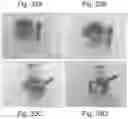 Fig. 42 - Abuse deterrent formulations of amphetamine