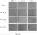 Fig. 05 - Methotrexate for proliferative vitreoretinopathy