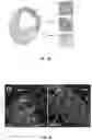 Fig. 11 - Methods and compositions for enhancing cardiomyocyte maturation and engraftment