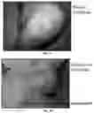 Fig. 09 - Tecoma plant based compositions for treating skin lesions