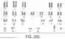 Fig. 46 - HUMAN APPLICATION OF ENGINEERED CHIMERIC ANTIGEN RECEPTOR (CAR) T-CELLS