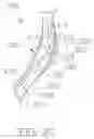 Fig. 04 - Methods, medical devices and kits for modifying the luminal profile of a body vessel