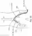 Fig. 13 - Orientable catheter, device and method of surgical intervention
