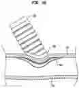 Fig. 06 - Delivery system for implantable flow connector