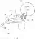 Fig. 02 - URETHRAL BALLOON DILATOR CATHETER