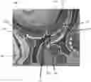 Fig. 01 - Electrical inhibition (EI) uterine pacemaker for controlling uterine contractions