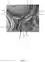 Fig. 04 - Electrical inhibition (EI) uterine pacemaker for controlling uterine contractions