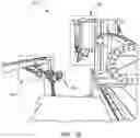 Fig. 03 - Device implantation using a cartridge