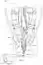 Fig. 04 - Device implantation using a cartridge