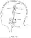 Fig. 25 - Device implantation using a cartridge