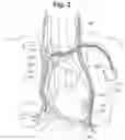 Fig. 03 - System and Method to Modulate Phrenic Nerve to Prevent Sleep Apnea