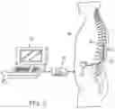 Fig. 03 - SYSTEM AND METHOD FOR DELIVERING MODULATED SUB-THRESHOLD THERAPY TO A PATIENT