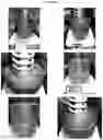 Fig. 23 - Electrosorptive cavitation devices and methods for phase separation