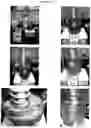 Fig. 24 - Electrosorptive cavitation devices and methods for phase separation