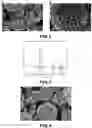 Fig. 02 - Iridium and / or iridium oxide microsphere-based porous material, preparation method therefor, and uses thereof