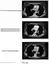 Fig. 16 - DDR2 Mutations in Squamous Cell Lung Cancer