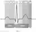 Fig. 06 - Electrocardiogram waveform signal processing method and apparatus