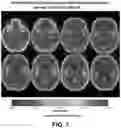 Fig. 07 - Systems and methods for evaluating the brain after onset of a stroke using computed tomography angiography