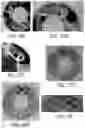 Fig. 43 - APPARATUS, SYSTEMS, AND METHODS FOR RAPID CANCER DETECTION