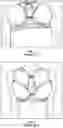 Fig. 02 - Chest wall adapter device