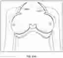 Fig. 16 - Chest wall adapter device