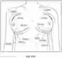 Fig. 22 - Chest wall adapter device