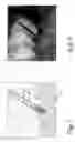 Fig. 09 - Bio-resorbable debride or implant cleaning tool and method of manufacturing the same