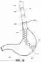 Fig. 20 - Segmented instrument having braking capabilities