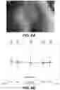 Fig. 12 - Apparatus and methods for determining damaged tissue using sub epidermal moisture measurements