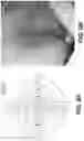 Fig. 13 - Apparatus and methods for determining damaged tissue using sub epidermal moisture measurements