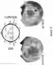 Fig. 16 - Lancing device having anesthetic feature