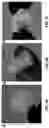 Fig. 06 - THIN, SOFT, SKIN-MOUNTED MICROFLUIDIC NETWORKS FOR DETECTION AND ANALYSIS OF TARGETS OF INTEREST IN SWEAT
