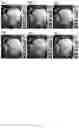 Fig. 08 - METHOD AND SYSTEM OF OBSTRUCTED AREA DETERMINATION FOR SLEEP APNEA SYNDROME