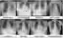 Fig. 01 - Method and system of building hospital-scale chest X-ray database for entity extraction and weakly-supervised classification and localization of common thorax diseases