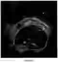 Fig. 05 - Ultrasound three-dimensional (3-D) segmentation