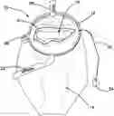 Fig. 01 - TISSUE REMOVAL CONTAINMENT SYSTEMS