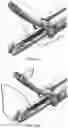Fig. 49 - Automatically reloading suture passer devices and methods