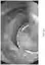 Fig. 08 - Video-guided endoluminal stapling method and system