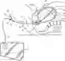 Fig. 01 - Introducer for uterine tamponade assembly with echogenic element and methods of using the same