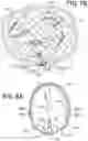 Fig. 06 - Intrasaccular device positioning and deployment system