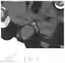Fig. 04 - MIS multi-level compressor / distractor