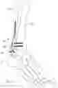 Fig. 49 - METHOD OF BONE FIXATION