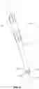 Fig. 08 - Surgical fixation assembly and methods of use
