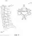 Fig. 06 - Robotic system and method for bone preparation for intervertebral disc prosthesis implantation