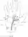 Fig. 04 - Therapeutic skin lifting device and related systems and methods