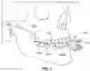 Fig. 08 - MOUTHPIECE FOR APPLICATION OF VIBRATION TO DENTITION