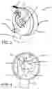 Fig. 03 - DENTAL ARTICULATOR CAPABLE OF FIXED HORIZONTAL CONDYLE AND ADJUSTABLE HORIZONTAL CONDYLE